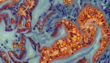 Pancreatic Cancer Switch Drives Chemotherapy Resistance