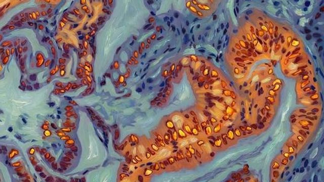 Pancreatic Cancer Switch Drives Chemotherapy Resistance