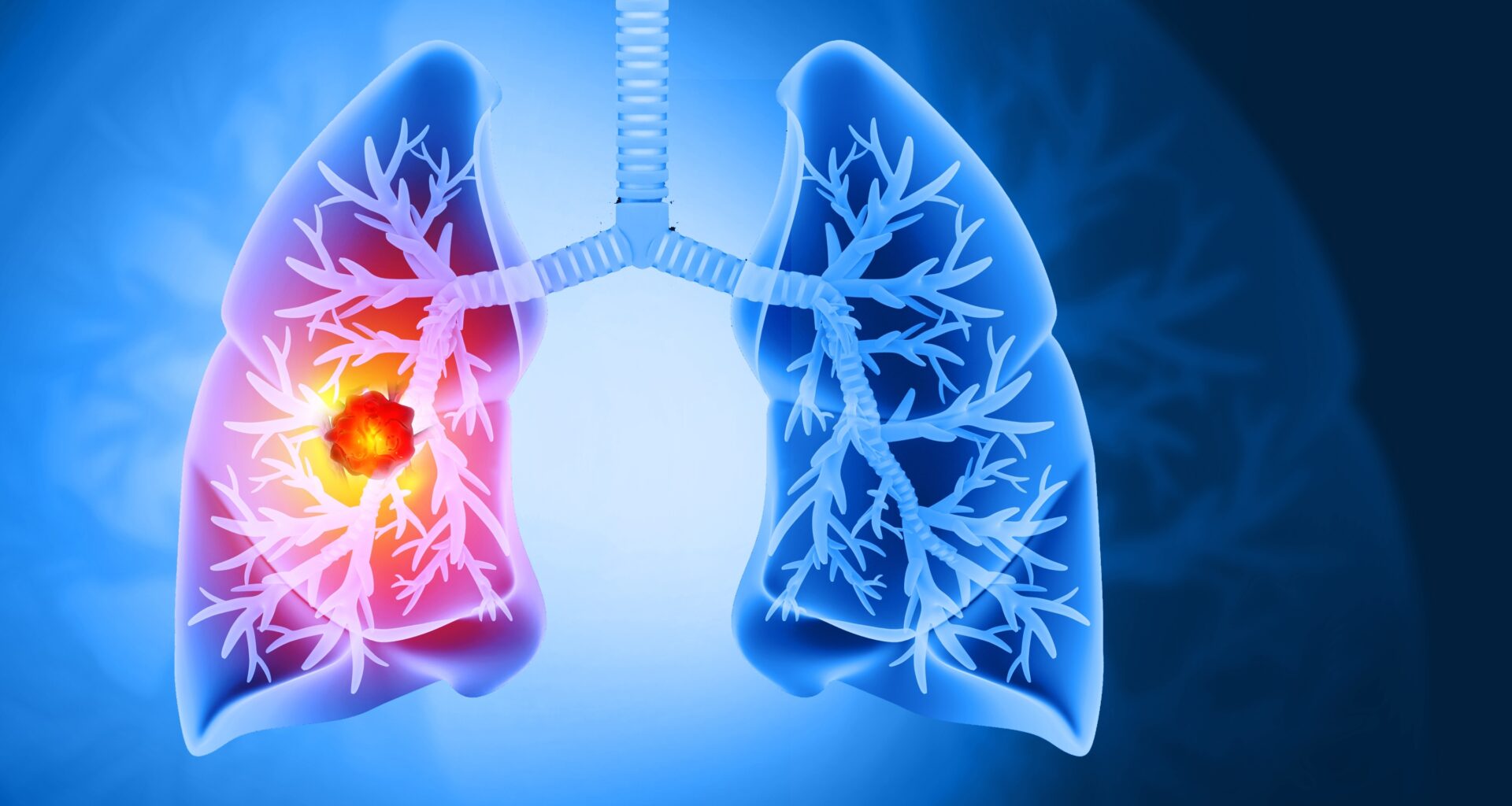 Blocking growth hormone may improve resistant lung cancer treatment