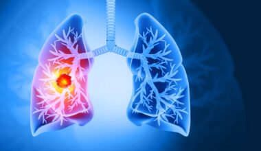 Blocking growth hormone may improve resistant lung cancer treatment