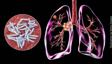 How Fred Hutch scientists tackle world’s top infectious killer, TB