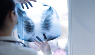CT Body Composition Predicts Risk in Lung Cancer Screening - EMJ