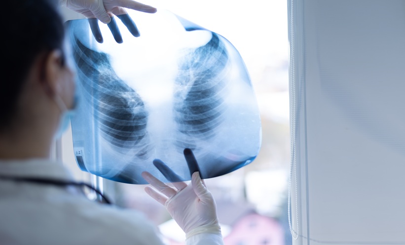 CT Body Composition Predicts Risk in Lung Cancer Screening - EMJ