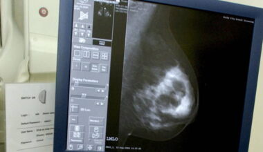 Tipperary nurse sues over alleged delay in breast cancer diagnosis