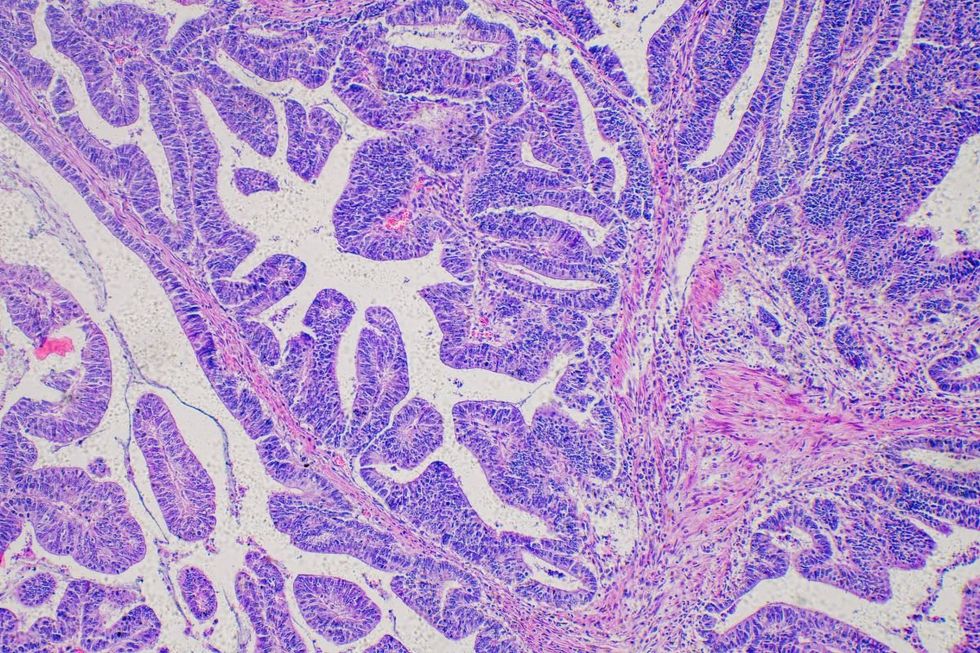 TUMOUR CANCER TISSUE