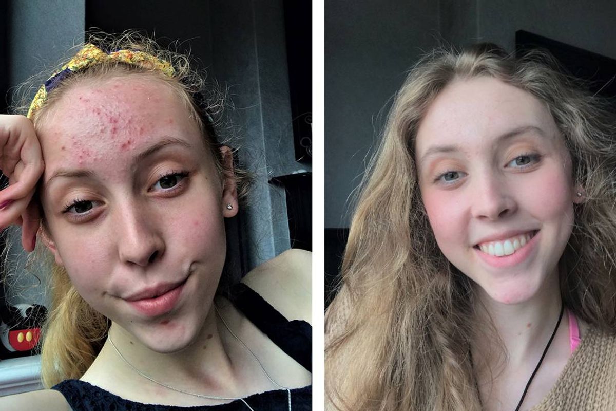 The image consists of two portraits of a young individual. The left portrait shows the person with a noticeable skin condition, possibly acne, and a serious expression. The right portrait depicts the same individual with a healthy, clear complexion and a cheerful expression. Both images are captured in a casual setting.