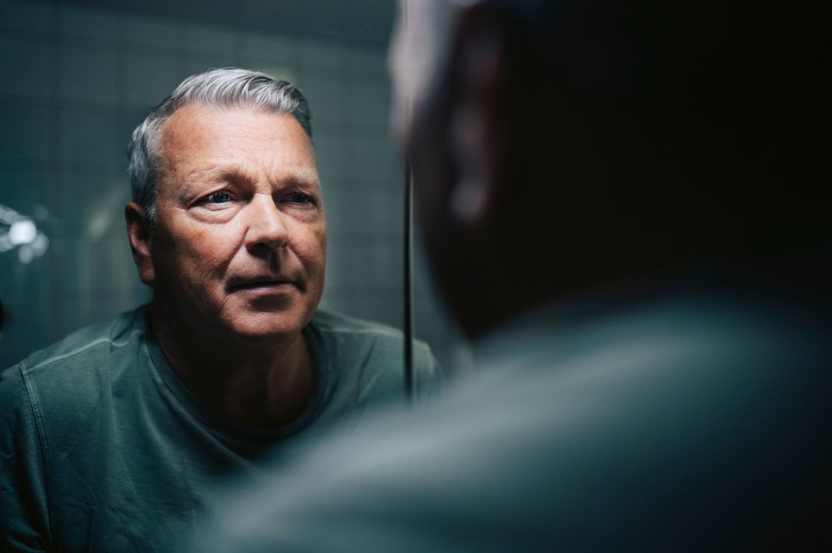 Two lesser-known signs of high cholesterol can be seen on the face - stock photo