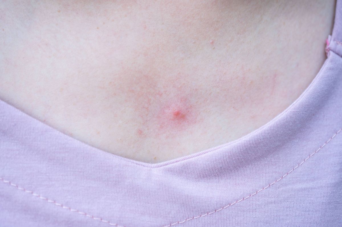 Acne in women is often associated with anxiety and depression.
