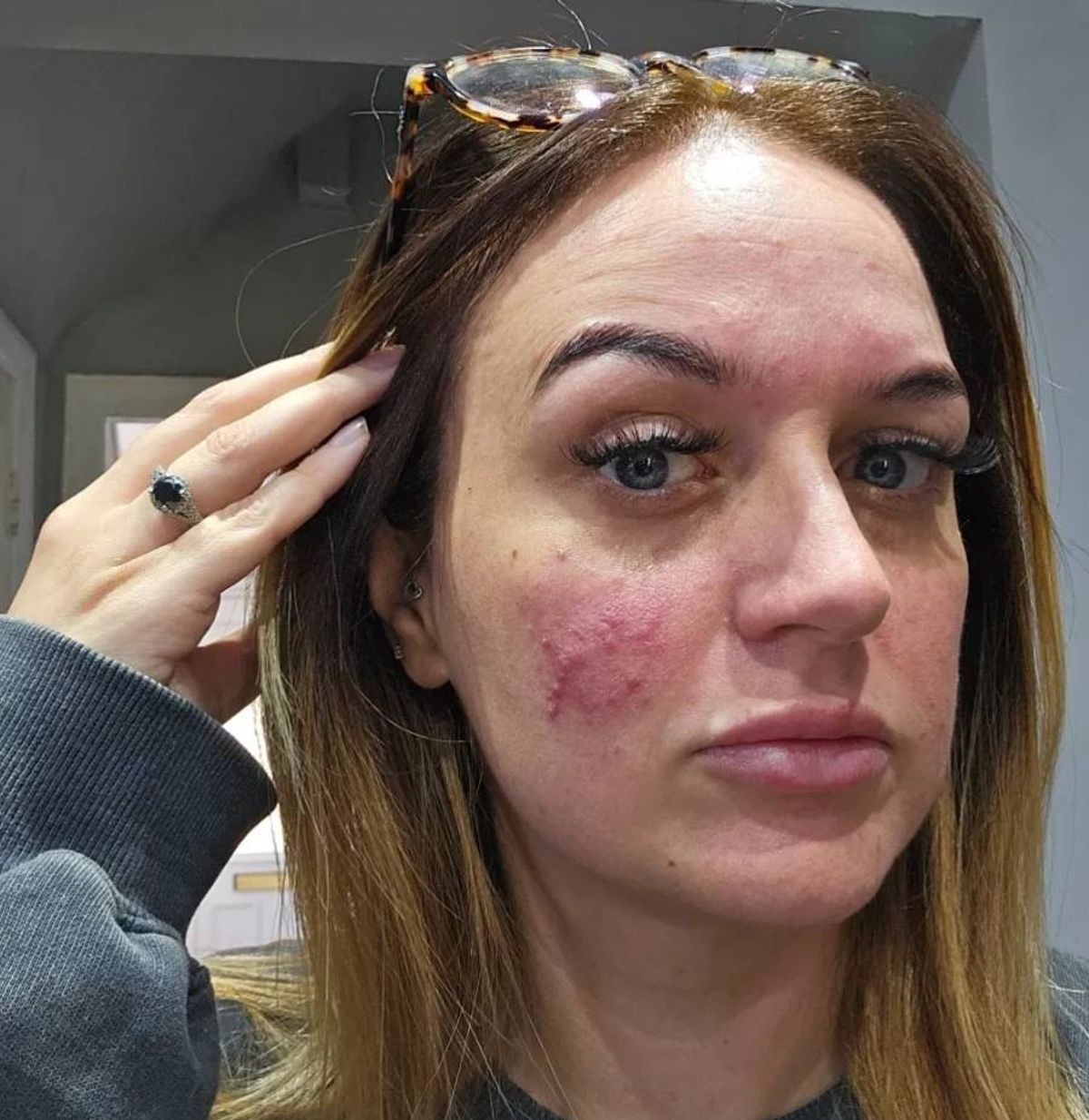 An individual with long hair, dressed in a dark jacket, is shown in a close-up view, their face displaying visible signs of reddening and inflammation on the skin. The individual's hand is placed gently on the forehead.