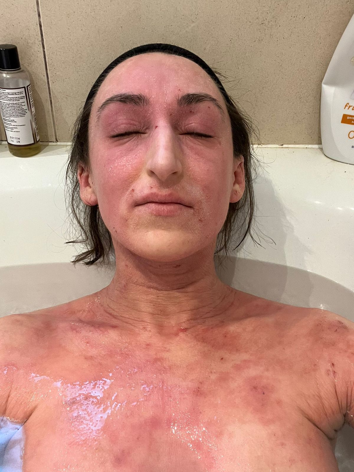 Rosemary in bath showing dry skin