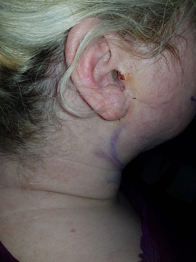 Some of the mysterious stitches Michelle found all over her body