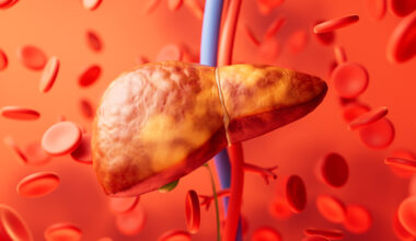 Cholesterol regulatory genes predict liver transplant outcomes