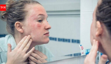 Recurring rashes, acne or redness? Dermatologists reveal hidden triggers behind skin inflammation, flare-ups