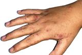 thumbnail: The rash may leave dark spots on brown or black skin.