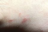 thumbnail: Tiny mites lay eggs in the skin. This looks like a raised line with a dot at one end.