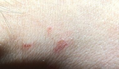 Student union warns of scabies outbreak at Waterford campus