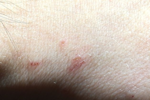 Student union warns of scabies outbreak at Waterford campus