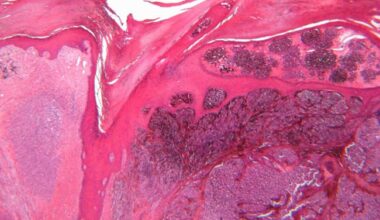 NIH-funded AI model predicts cancer survival from single-cell tumor data 