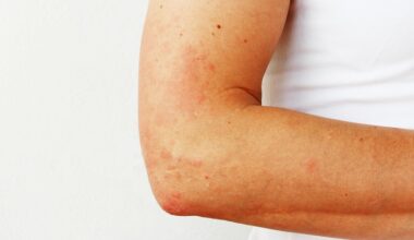 Photopatch Testing Improves Photoallergy Detection - EMJ