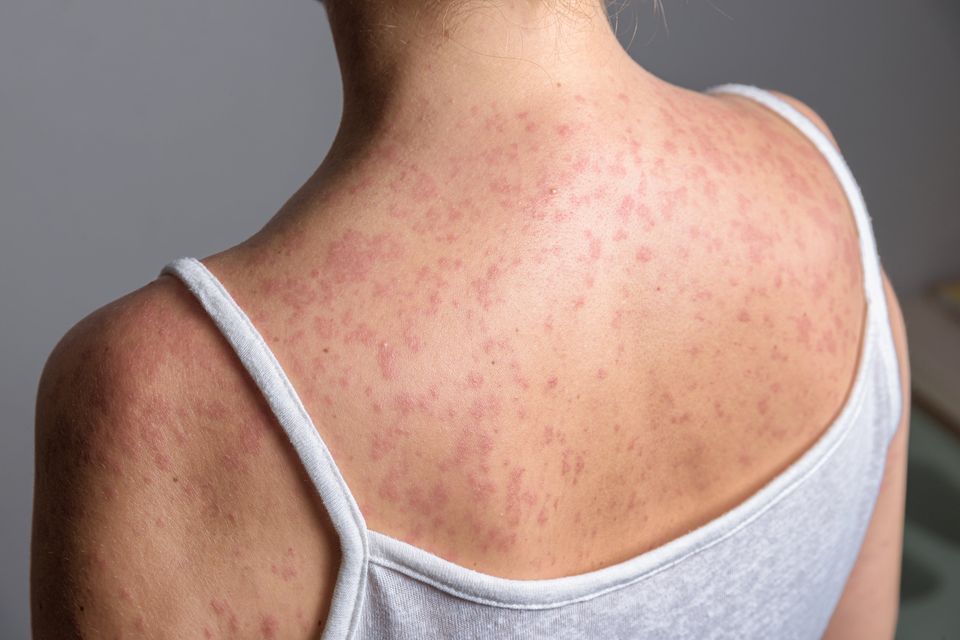 Contracting measles can lead to severe complications. Stock image: Getty
