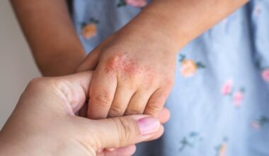 Machine Learning Predicts Childhood Asthma Risk