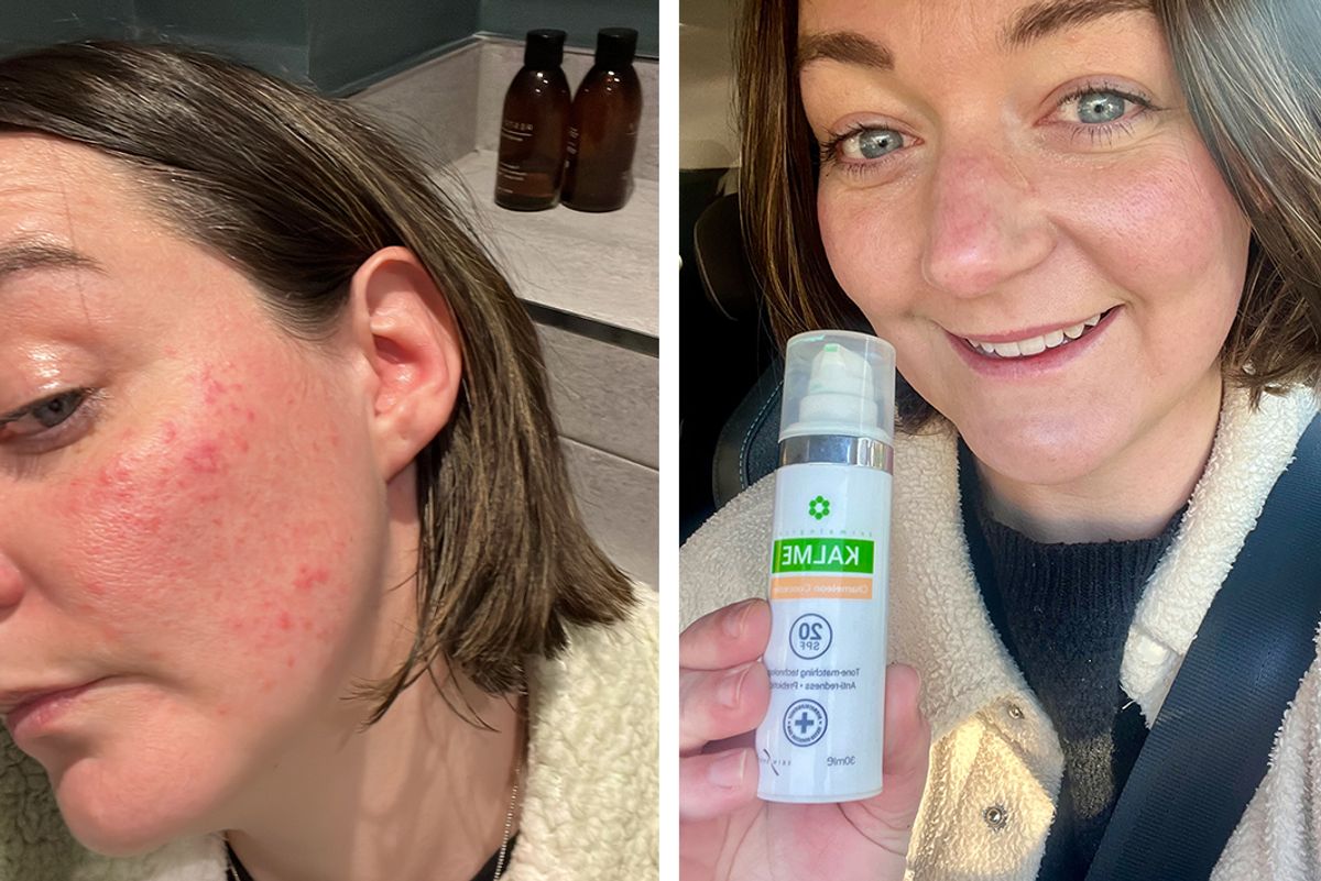 One user shared their results before and after using Kalme