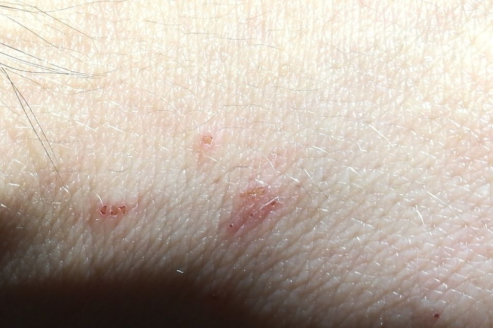 Tiny mites lay eggs in the skin. This looks like a raised line with a dot at one end.