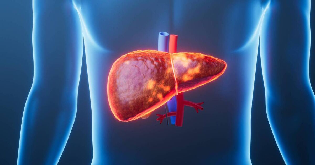 Liver disease to affect 1.8 billion people worldwide by 2050, study suggests