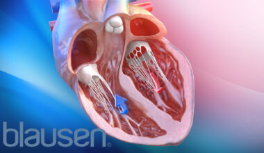 Scientists Find People with Severe Obesity and Heart Failure Have Weakened Heart Muscle Contractions. Weight Loss May Reverse This Condition