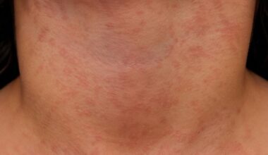 Oregon reports 1st measles hospitalization of 2026 | Redmond News