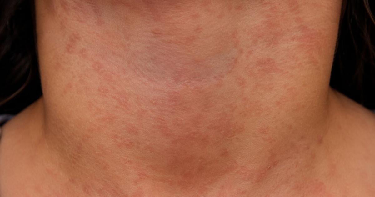Oregon reports 1st measles hospitalization of 2026 | Redmond News