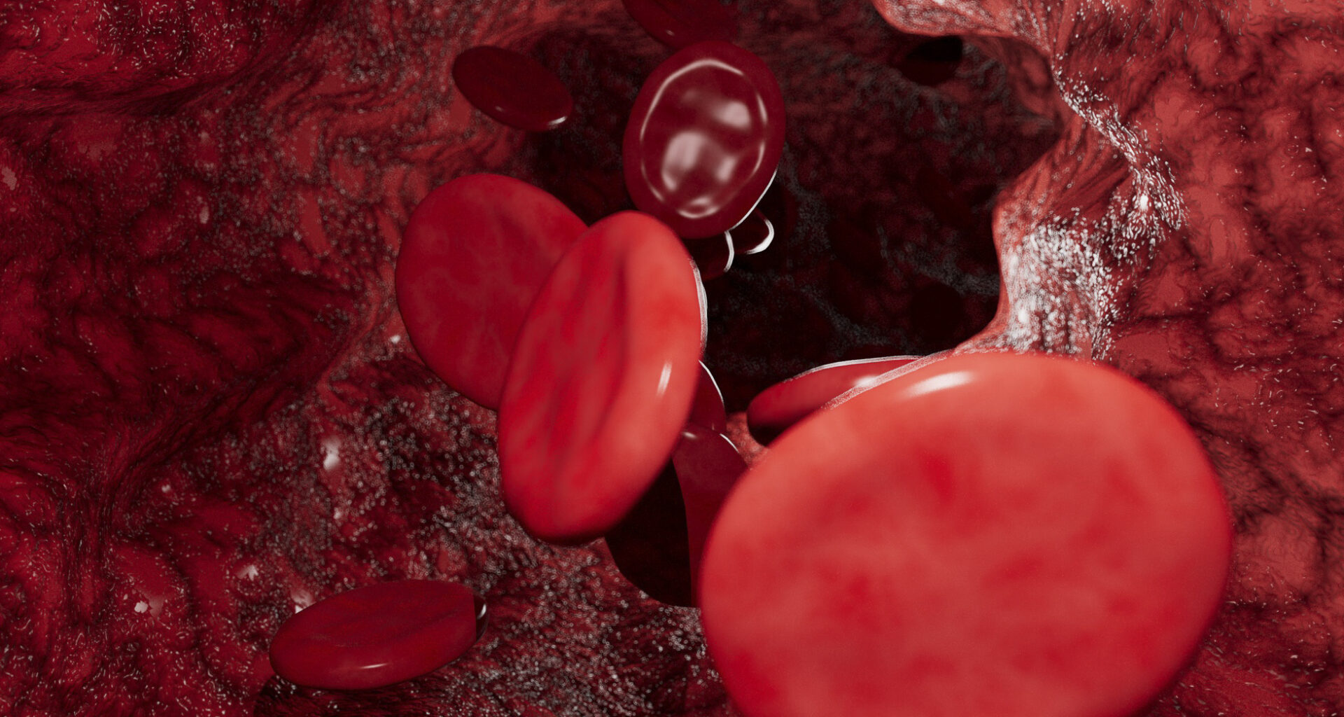 Stents Can Ease Symptoms of Post-Thrombotic Syndrome  
