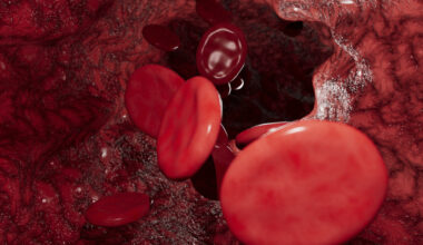Stents Can Ease Symptoms of Post-Thrombotic Syndrome  