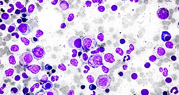 myelofibrosis