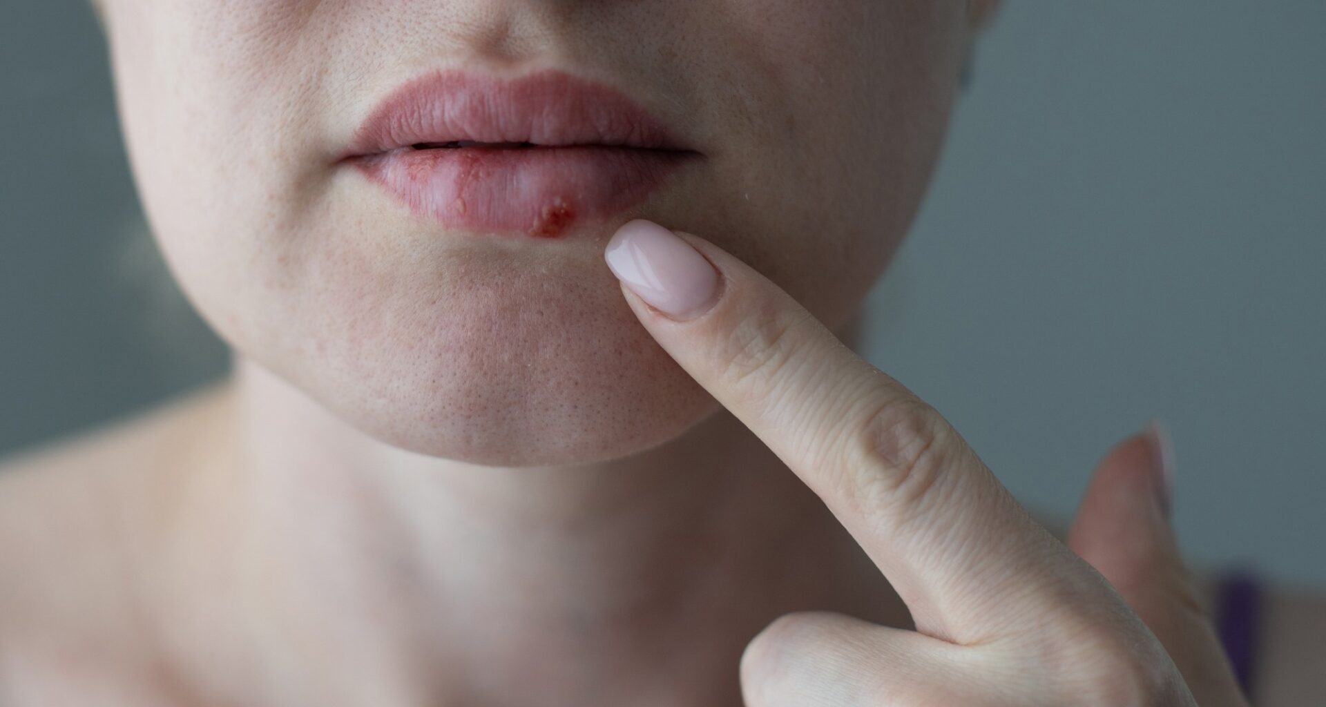 The woman with a virus herpes on lips