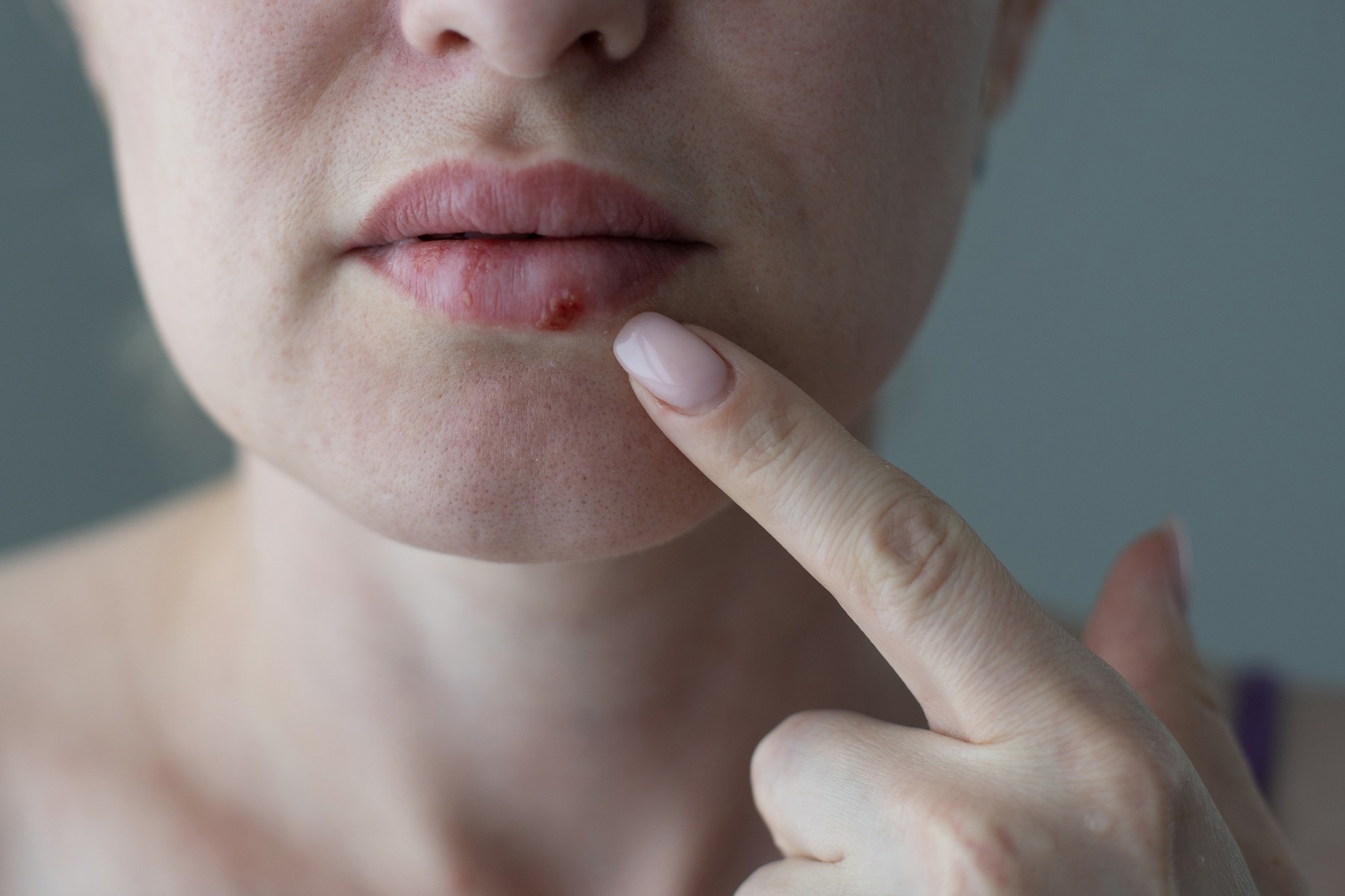 The woman with a virus herpes on lips