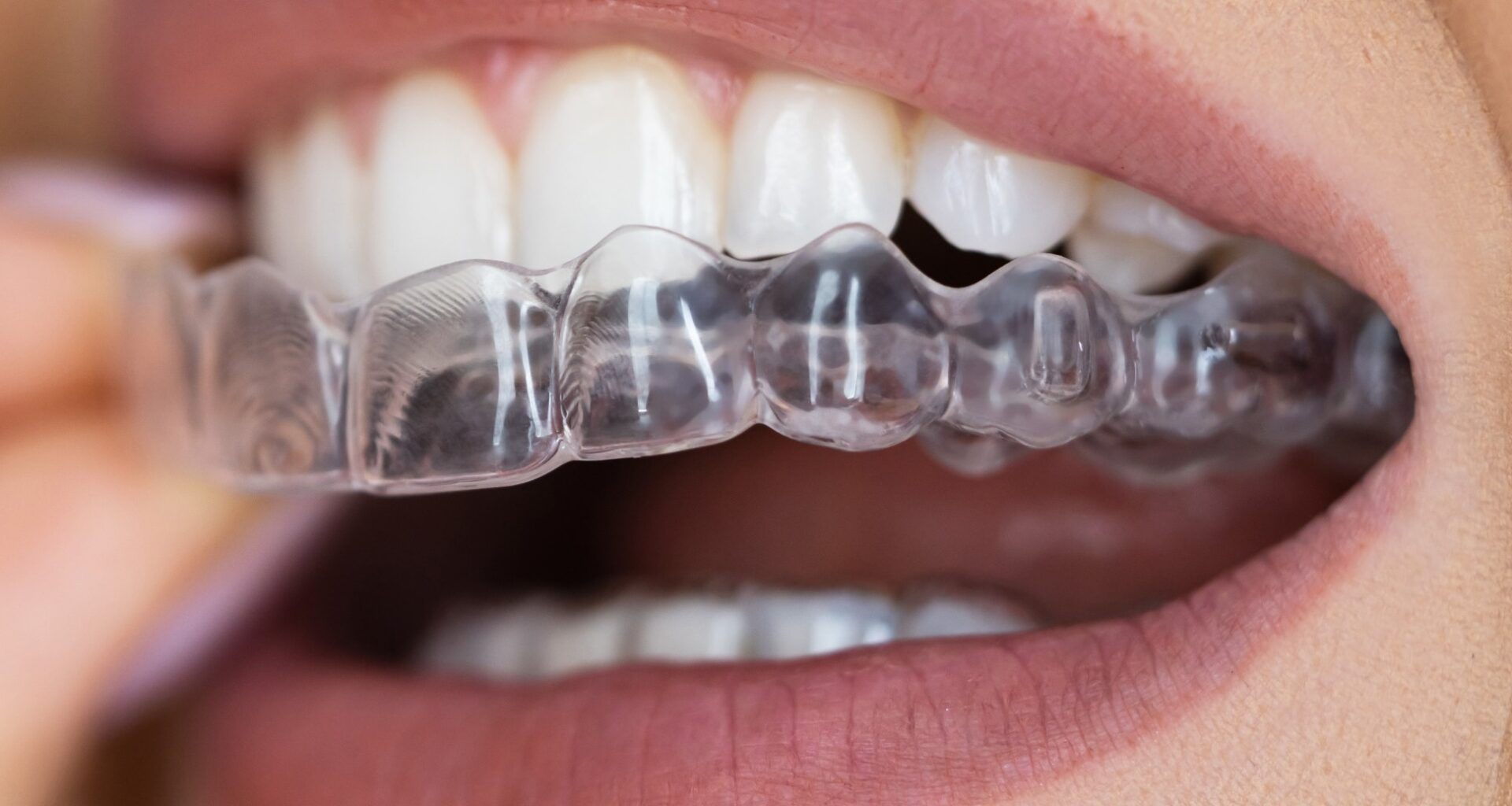 Study: The Changes of Microbiome Attached on Clear Aligners after Drinking Coca-Cola. Image Credit: Andrey_Popov / Shutterstock