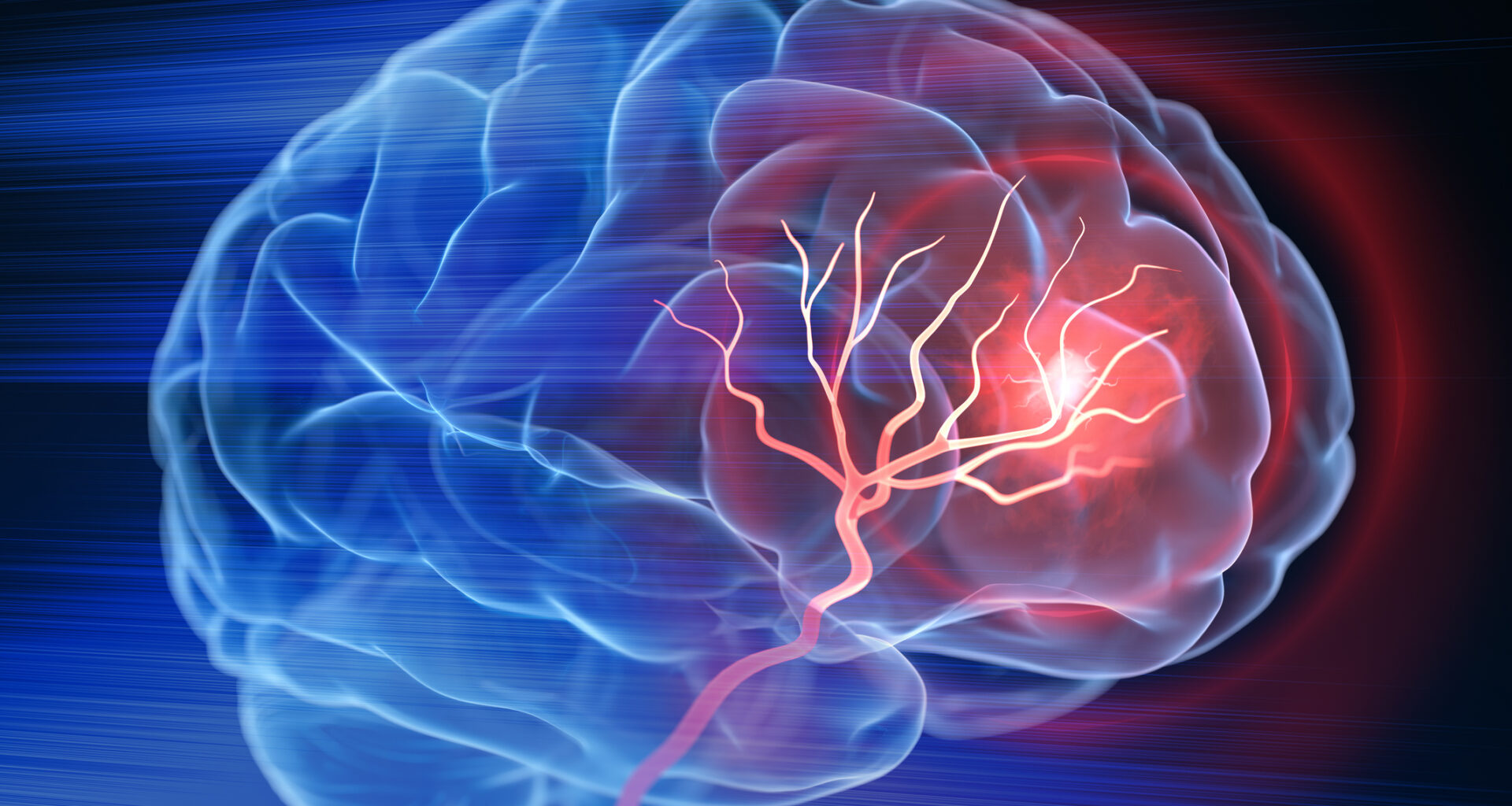 Low Birthweight Increases Risk of Early Stroke