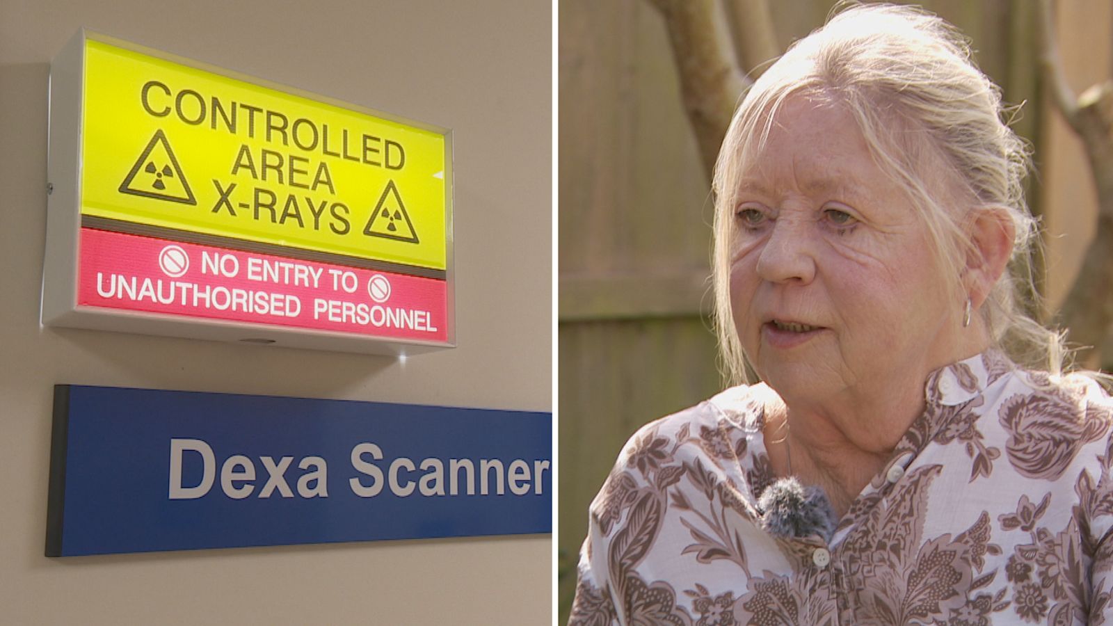 'It was horrifying': Jersey patient told she has osteoporosis eight years after bone density scan