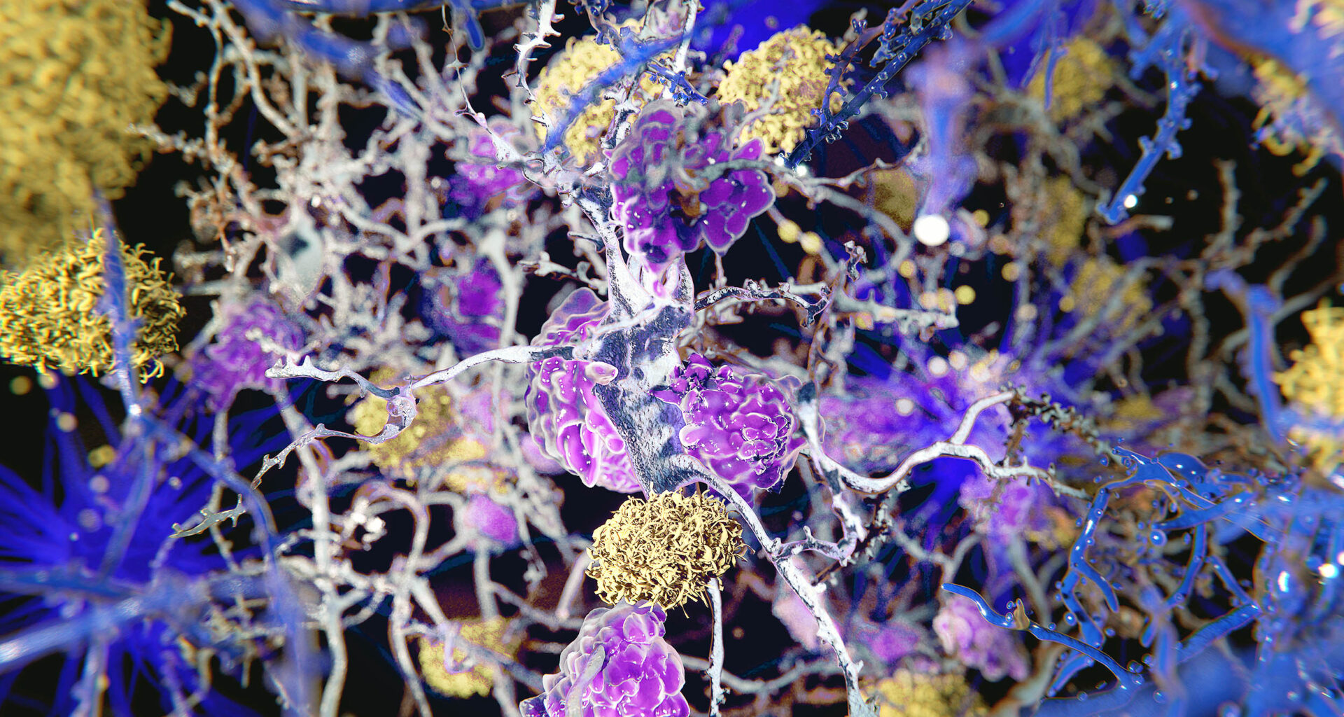 Alzheimer's may start in body tissue inflammation, not in the brain