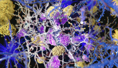 Alzheimer's may start in body tissue inflammation, not in the brain