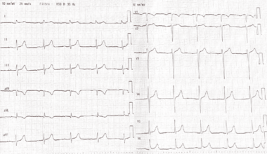 Obstructive Hypertrophic Cardiomyopathy and Interarterial Anomalous Aortic Origin of the Right Coronary Artery (AAORCA) Presenting With Syncope: Multimodal Diagnostic Assessment and Individualized Management