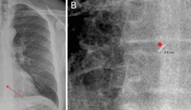 Pneumatic Nail Gun Injury to the Cardiac Box: A Case Report of Successful Extraction of a Potentially Dangerous Tool