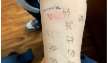 The Evolving Contribution of Cannabis Exposure to Peanut Allergy Development: A Case Report