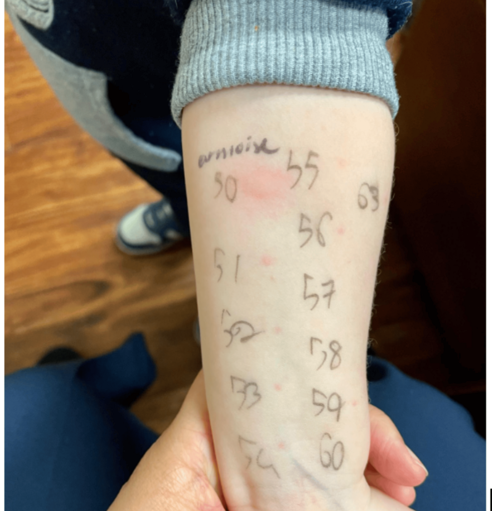 The Evolving Contribution of Cannabis Exposure to Peanut Allergy Development: A Case Report