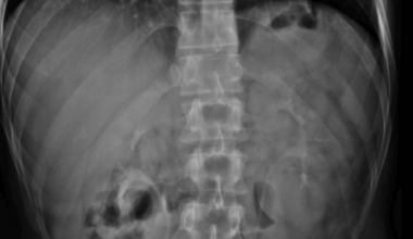 Life-Threatening Internal Hernia Through an Omental Band With Closed-Loop Obstruction in a Virgin Abdomen and Normal Laboratory Findings: A Case Report