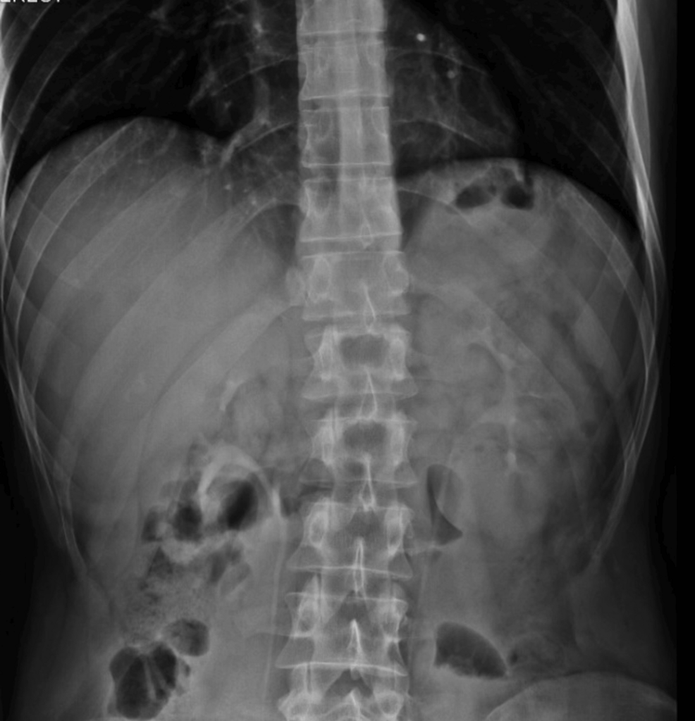Life-Threatening Internal Hernia Through an Omental Band With Closed-Loop Obstruction in a Virgin Abdomen and Normal Laboratory Findings: A Case Report