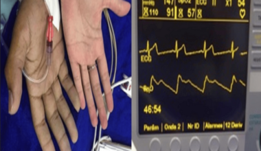 Saturation Gap During Anesthesia in Glucose-6-Phosphate Dehydrogenase Deficiency and Methemoglobinemia: A Case Report and Review of Perioperative Management