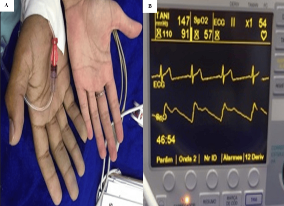 Saturation Gap During Anesthesia in Glucose-6-Phosphate Dehydrogenase Deficiency and Methemoglobinemia: A Case Report and Review of Perioperative Management