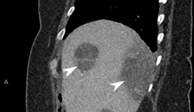 Cryptogenic Pyogenic Liver Abscess as a Sentinel of Occult Colorectal Cancer: Successful Conservative Management of a Rare Presentation